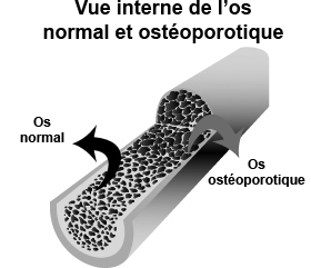 Ostéoporose - Uniprix