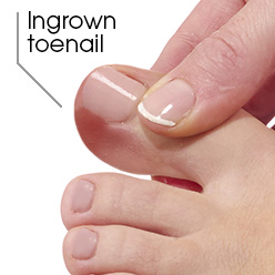 How to prevent and treat ingrown toenails |Uniprix - Uniprix How to prevent and treat ingrown toenails |Uniprix - Uniprix